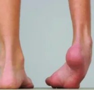 Complex Foot Surgery Tanda Medical College